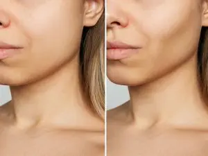 Cheek Enhancement