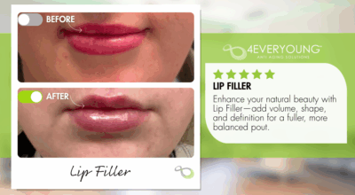 Juvederm Lip filler