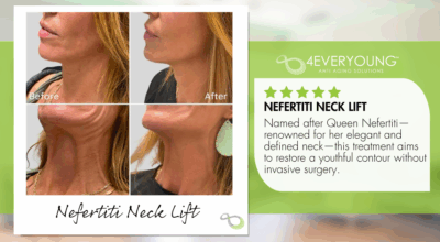 Nefertiti neck lift