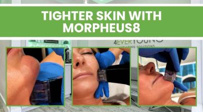 Morpheus8 Skin Tightening in Blue Bell, PA: What It Is, How It Works, and Why It Works