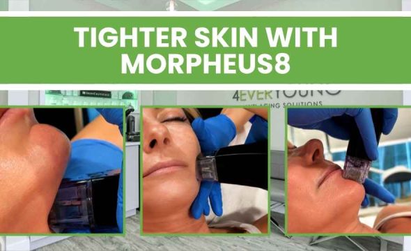  Morpheus8 Skin Tightening in Blue Bell, PA: What It Is, How It Works, and Why It Works 