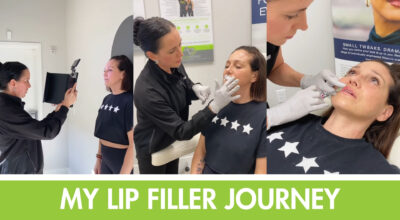Lip filler Bridgeport OR, lip injections Bridgeport, best lip filler near me, natural lip filler Oregon, lip augmentation Bridgeport, hyaluronic acid lip filler, subtle lip enhancement