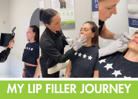 Lip filler Bridgeport OR, lip injections Bridgeport, best lip filler near me, natural lip filler Oregon, lip augmentation Bridgeport, hyaluronic acid lip filler, subtle lip enhancement