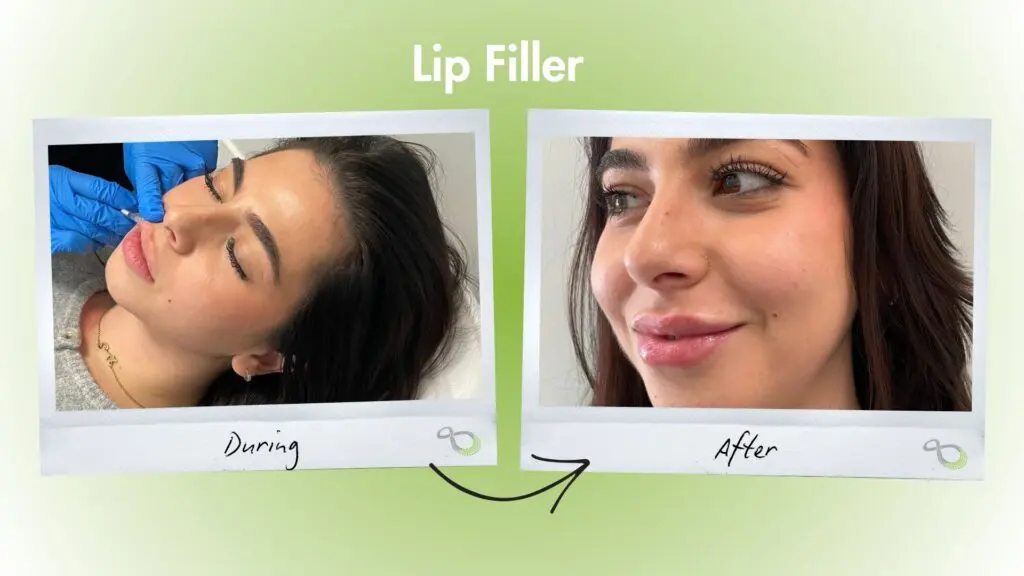 Lip Filler