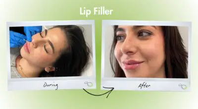 Lip Filler