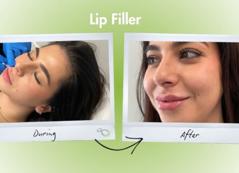 Lip Filler