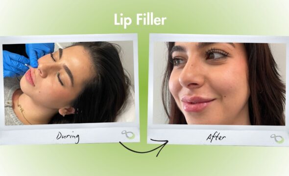  Get the Perfect Pout: The Best Lip Fillers in Chandler Pavilions 