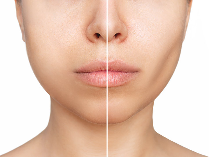 Cheek Enhancement