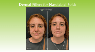 Nasolabial fold filler
