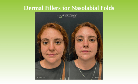  Smile Lines Be Gone: Achieve a Youthful Refresh with Dermal Fillers for Nasolabial Folds at 4Ever Young Doral 