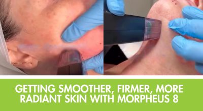 Morpheus8 Falls Church, RF microneedling VA, skin tightening Falls Church, non-surgical facelift Virginia, wrinkle treatment Morpheus8