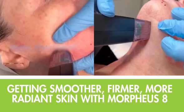  Smoother, Firmer, More Radiant Skin with Morpheus8 