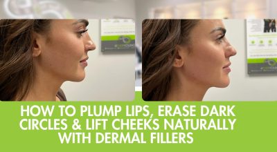 Natural Dermal Fillers in Fort Collins | Lips, Under-Eyes & Cheeks