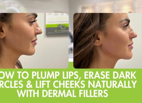 Natural Dermal Fillers in Fort Collins | Lips, Under-Eyes & Cheeks