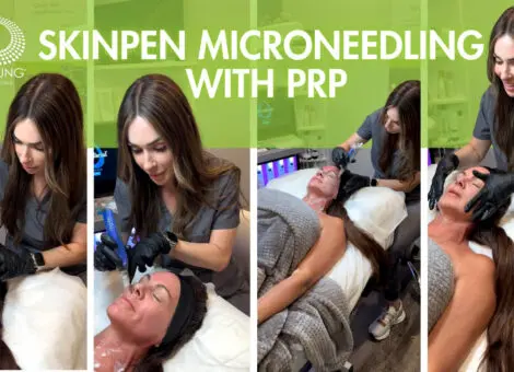 Skinpen Microneedling