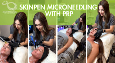 Skinpen Microneedling