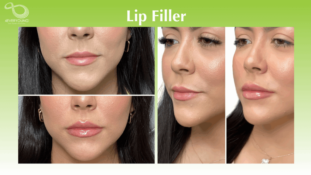 Lip Filler