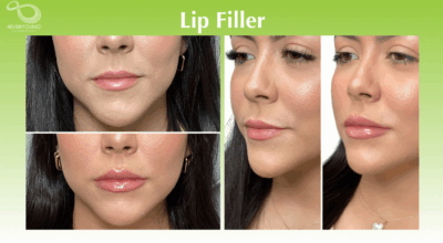 Lip Filler