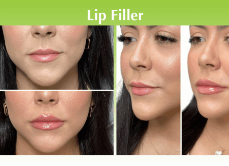 Lip Filler