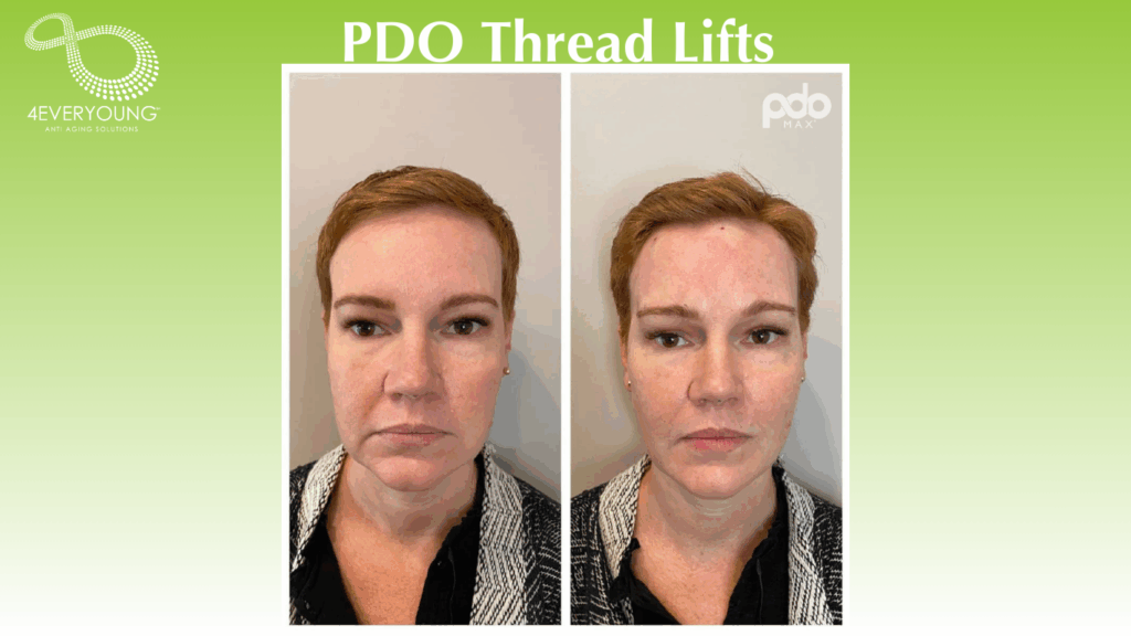 PDO thread lifts