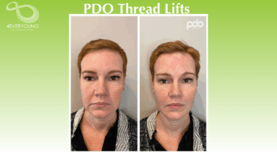 PDO thread lifts