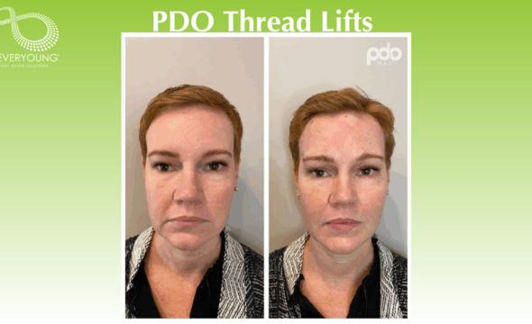  Turn Back Time with PDO Thread Lifts at 4Ever Young Fort Myers 