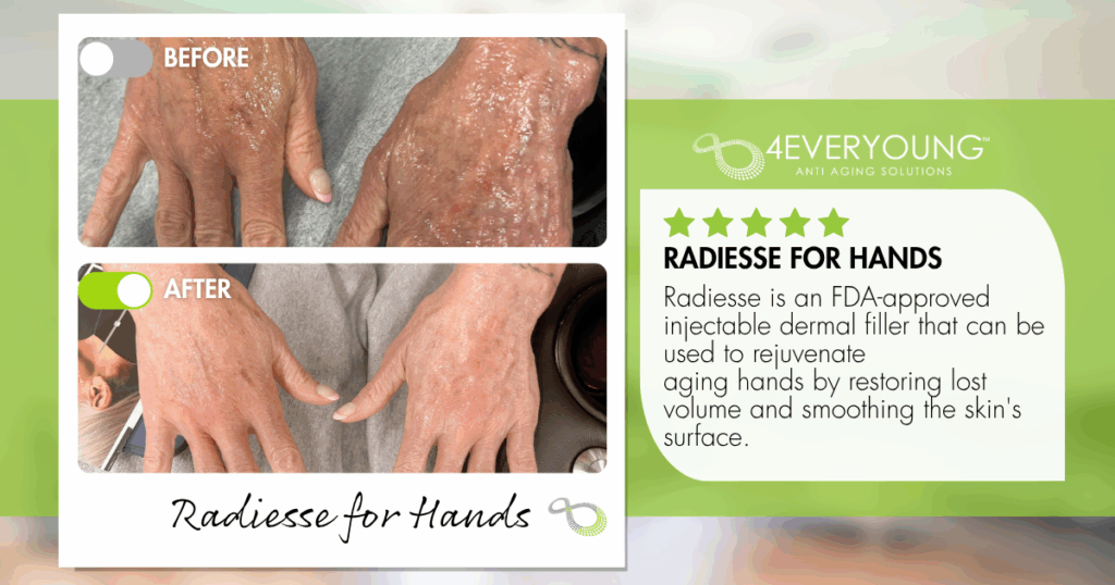 Radiesse for Hands