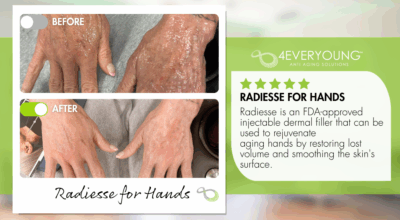 Radiesse hand rejuvenation treatment at 4Ever Young Fort Myers