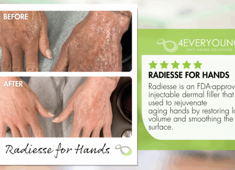 Radiesse hand rejuvenation treatment at 4Ever Young Fort Myers