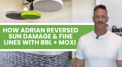 Moxi laser Fort Myers BBL Fort Myers sun damage treatment Fort Myers laser skin rejuvenation Fort Myers fine lines treatment Fort Myers 4Ever Young Fort Myers laser