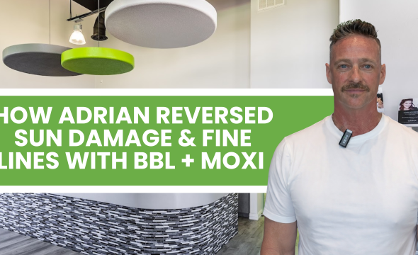  BBL & Moxi Laser in Fort Myers: How Adrian Treated Sun Damage, Fine Lines & Wrinkles 