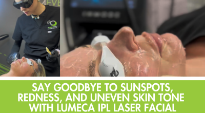 Lumeca IPL Frankfort, sunspot removal IPL, redness treatment laser IL, even skin tone laser Frankfort, IPL facial South Suburbs