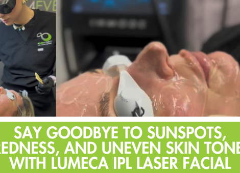 Lumeca IPL Frankfort, sunspot removal IPL, redness treatment laser IL, even skin tone laser Frankfort, IPL facial South Suburbs