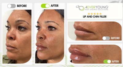 Lip & chin filler