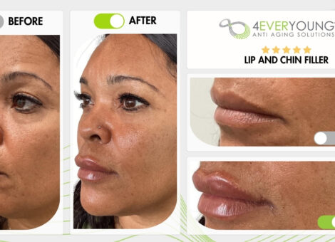 Lip & chin filler
