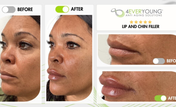 Enhance Your Natural Beauty with Lip & Chin Filler at 4Ever Young Gilbert, AZ