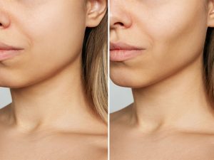 Cheek Enhancement