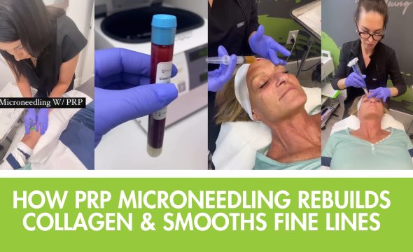  How PRP Microneedling Rebuilds Collagen & Smooths Fine Lines at 4Ever Young Katy 