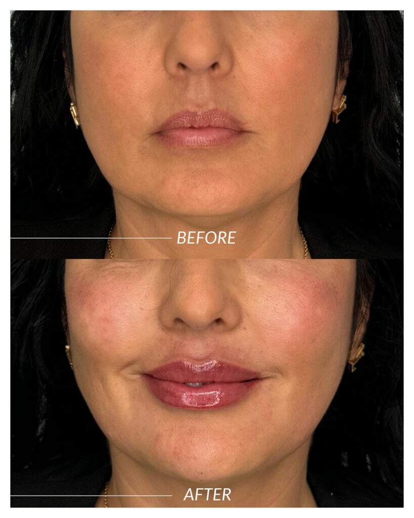 natural looking lip filler kingwood