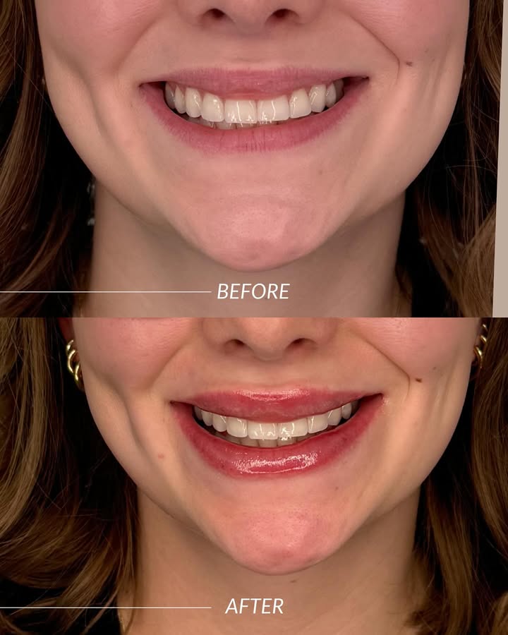 natural lip filler kingwood
