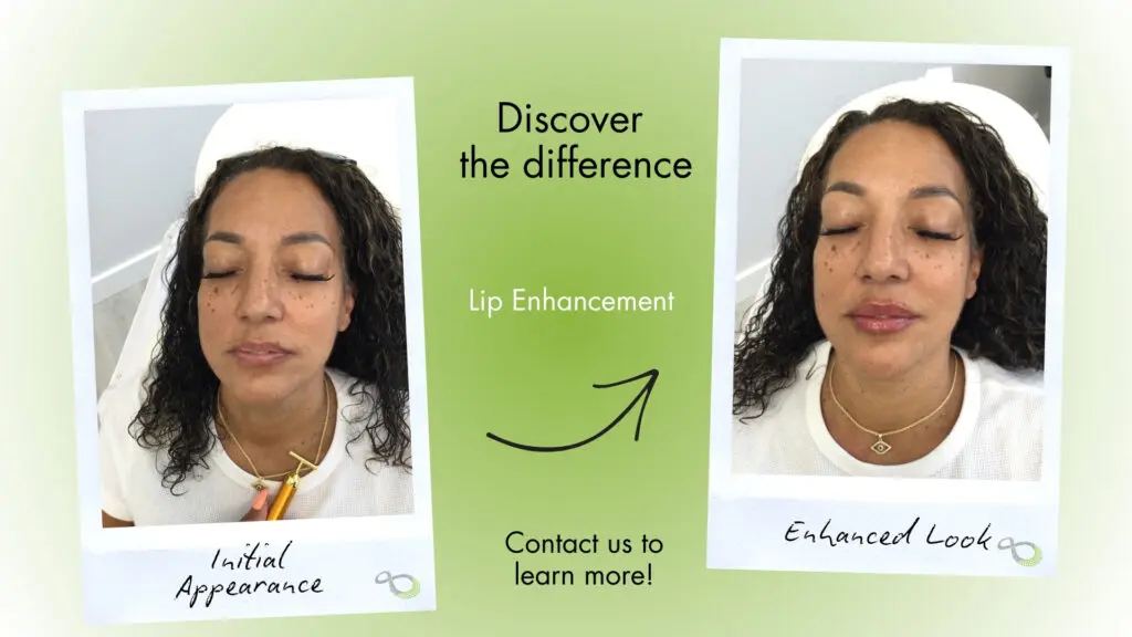 Lip augmentation Livingston NJ