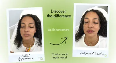 Lip augmentation Livingston NJ