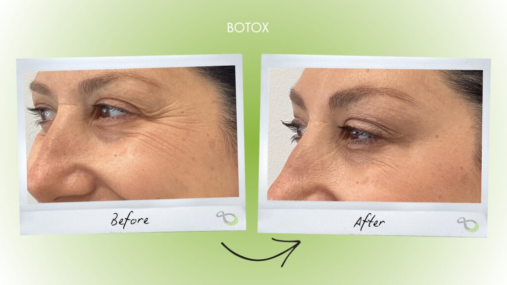 Botox Livingston