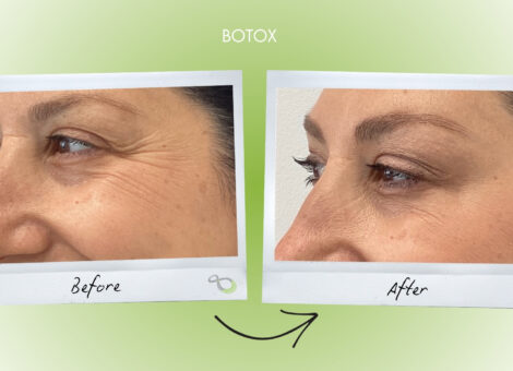Botox Livingston NJ