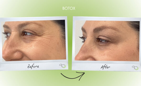  Understanding Botox: Benefits, Procedure, and What to Expect 