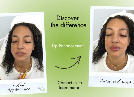 Lip augmentation Livingston NJ