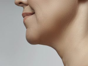 Double Chin Removal with Kybella in 4Ever Young Boca Raton, FL