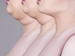Double Chin Removal with Kybella in 4Ever Young Boca Raton, FL