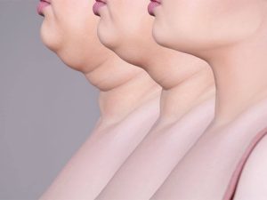 Double Chin Removal with Kybella Fort Myers FL
