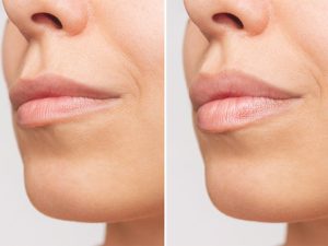 Lip Enhancement Arvada CO